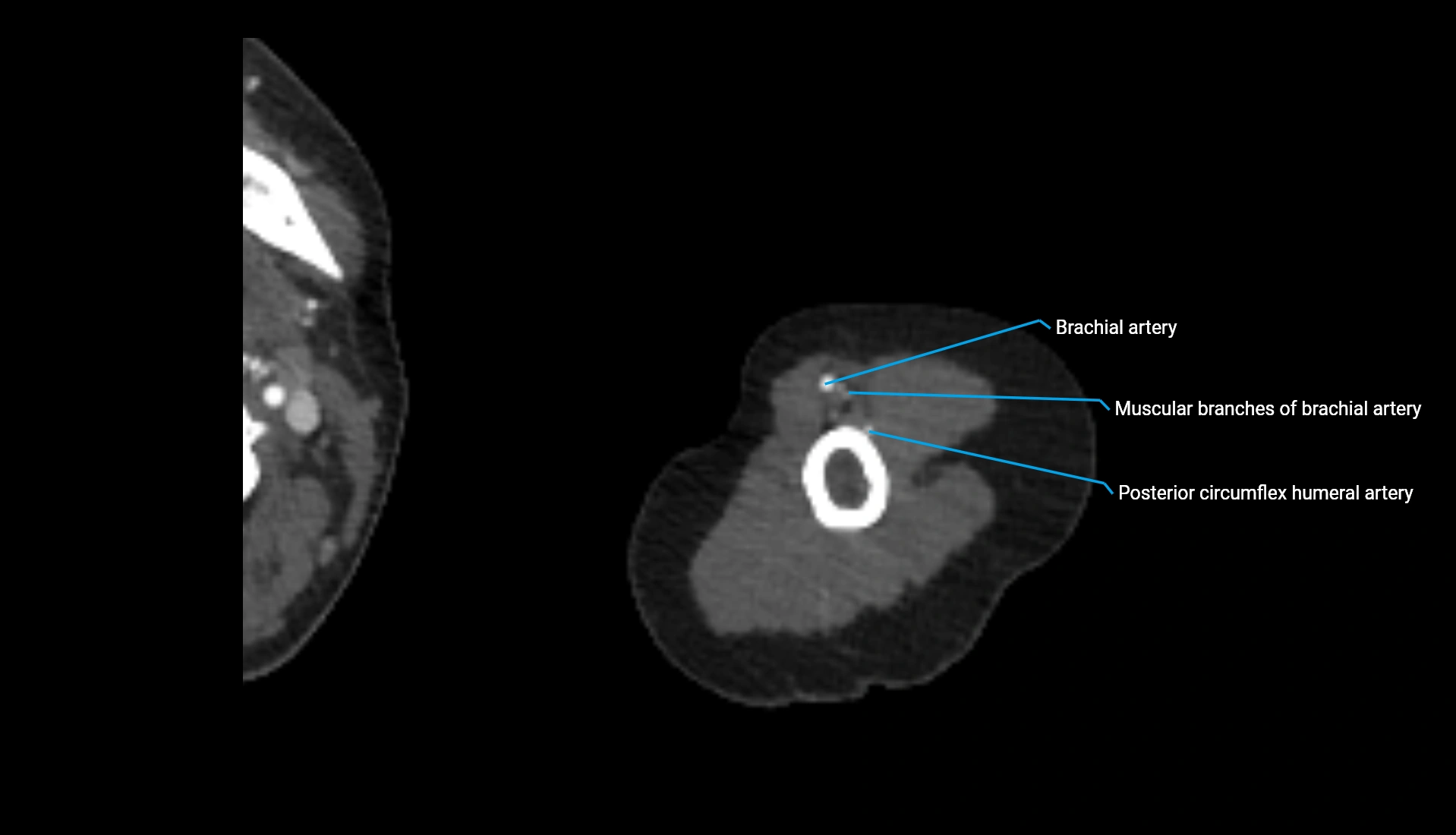 CTA upper limb axial cross sectional anatomy labelled image 292 (2).webp